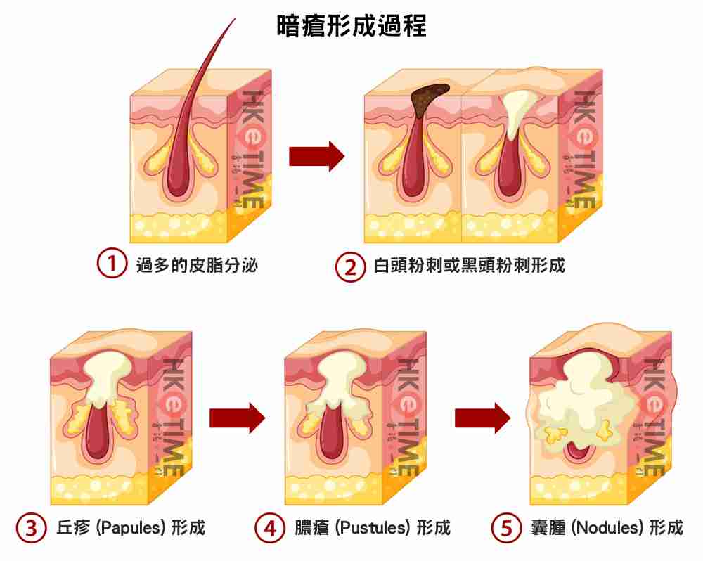暗瘡形成過程