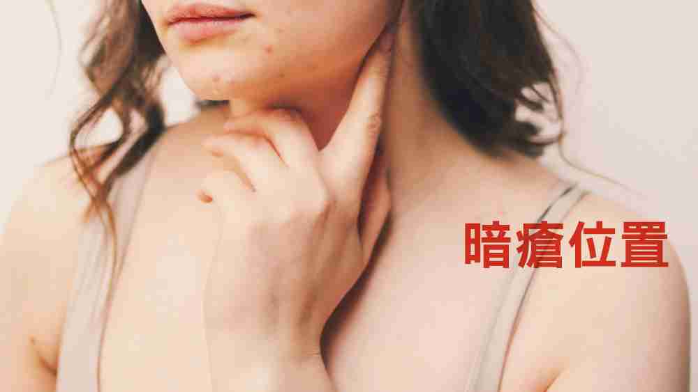 暗瘡位置