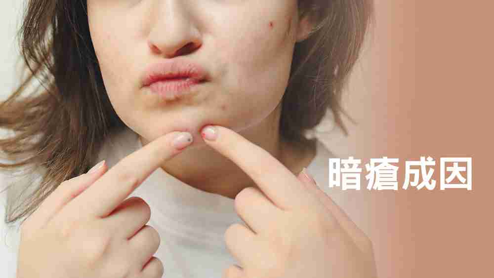 暗瘡成因
