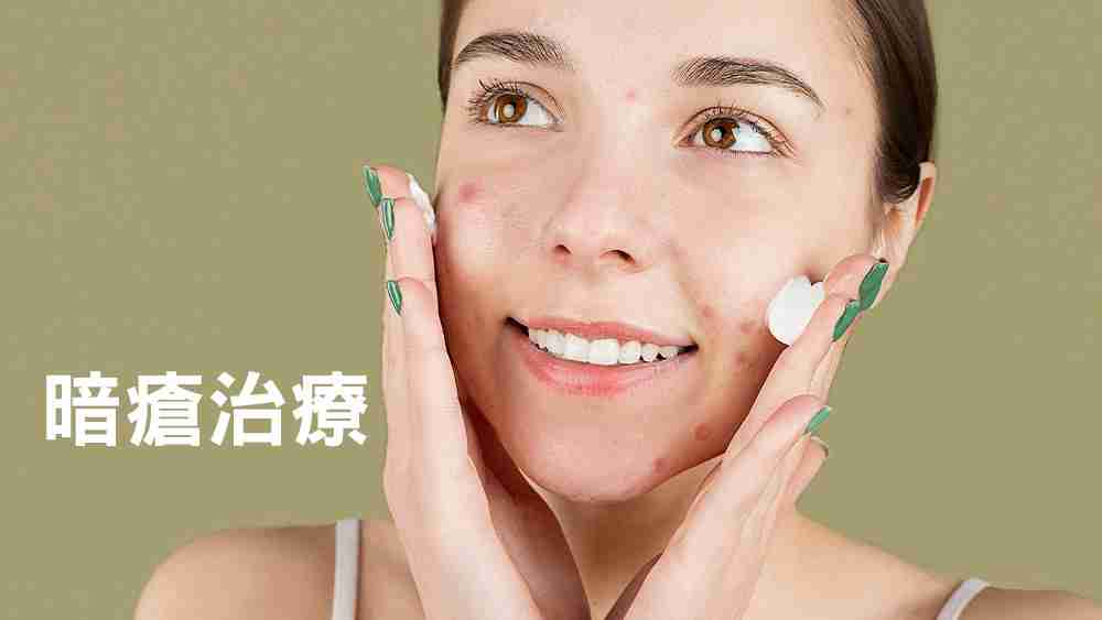 暗瘡治療