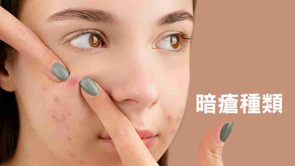 暗瘡種類