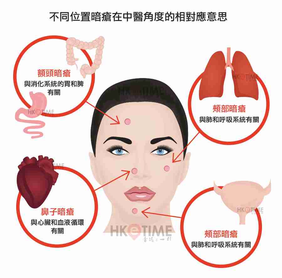 不同位置暗瘡在中醫角度的相對應意思