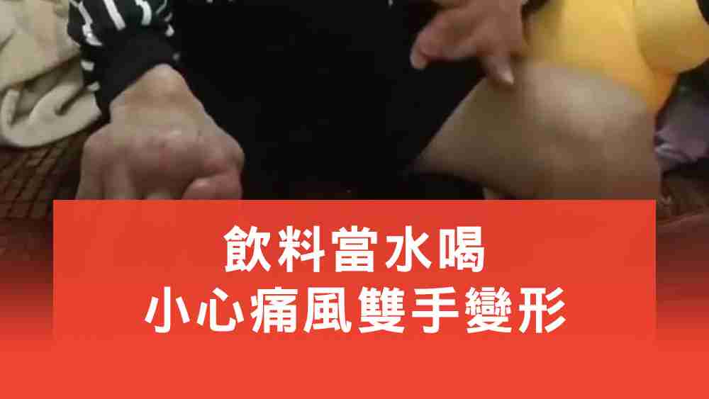 痛風雙手變形